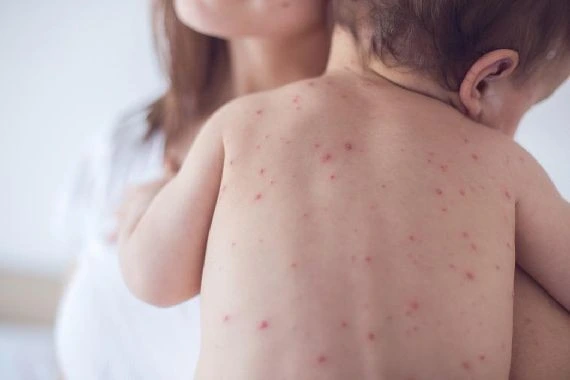 Sai lầm chết người: Vì sao nhiều trẻ mắc sởi dù đã có vaccine?