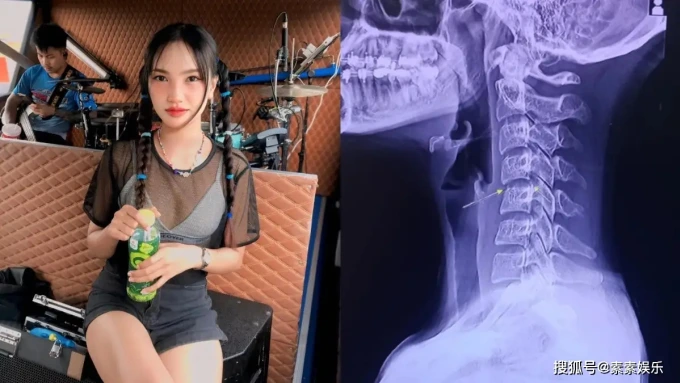 Kết quả chụp MRI cho thấy xương cổ của cô gái không gãy